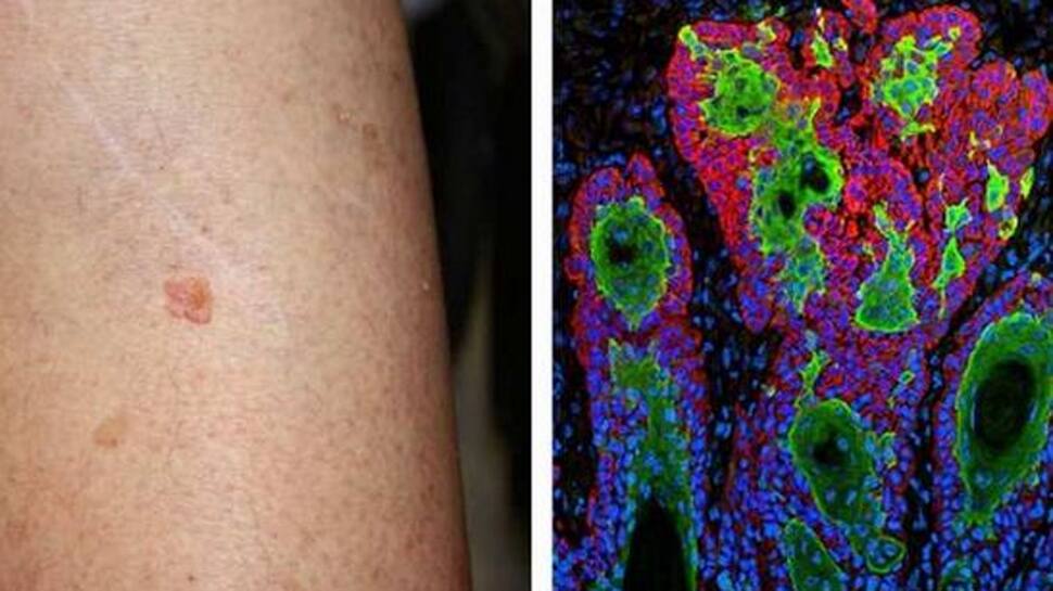 Skin Cancer ની સારવારમાં ભારતીય વૈજ્ઞાનિકોને મળી મોટી સફળતા