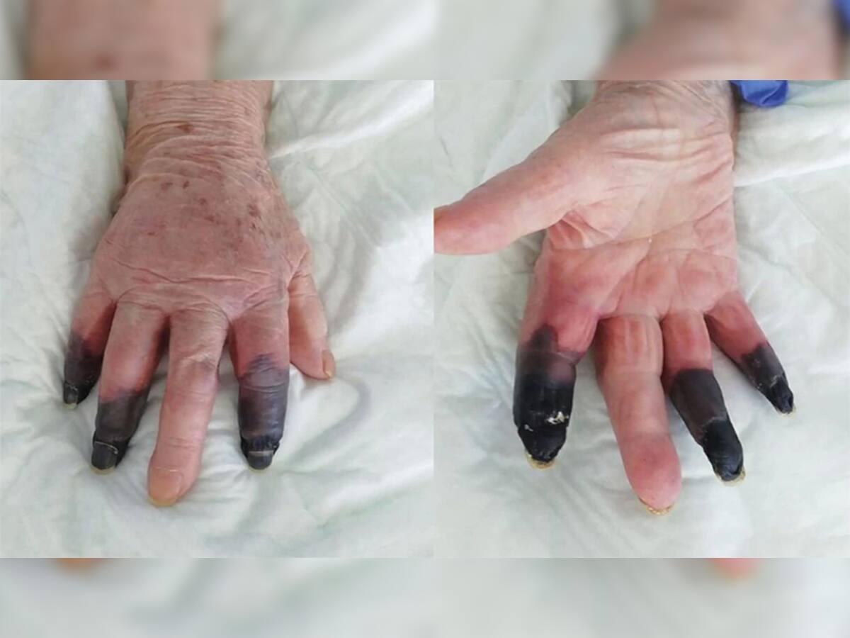 Corona Virus ની ભયંકર આડ અસર સામે આવી, મહિલાની 3 આંગળી કાપવી પડી