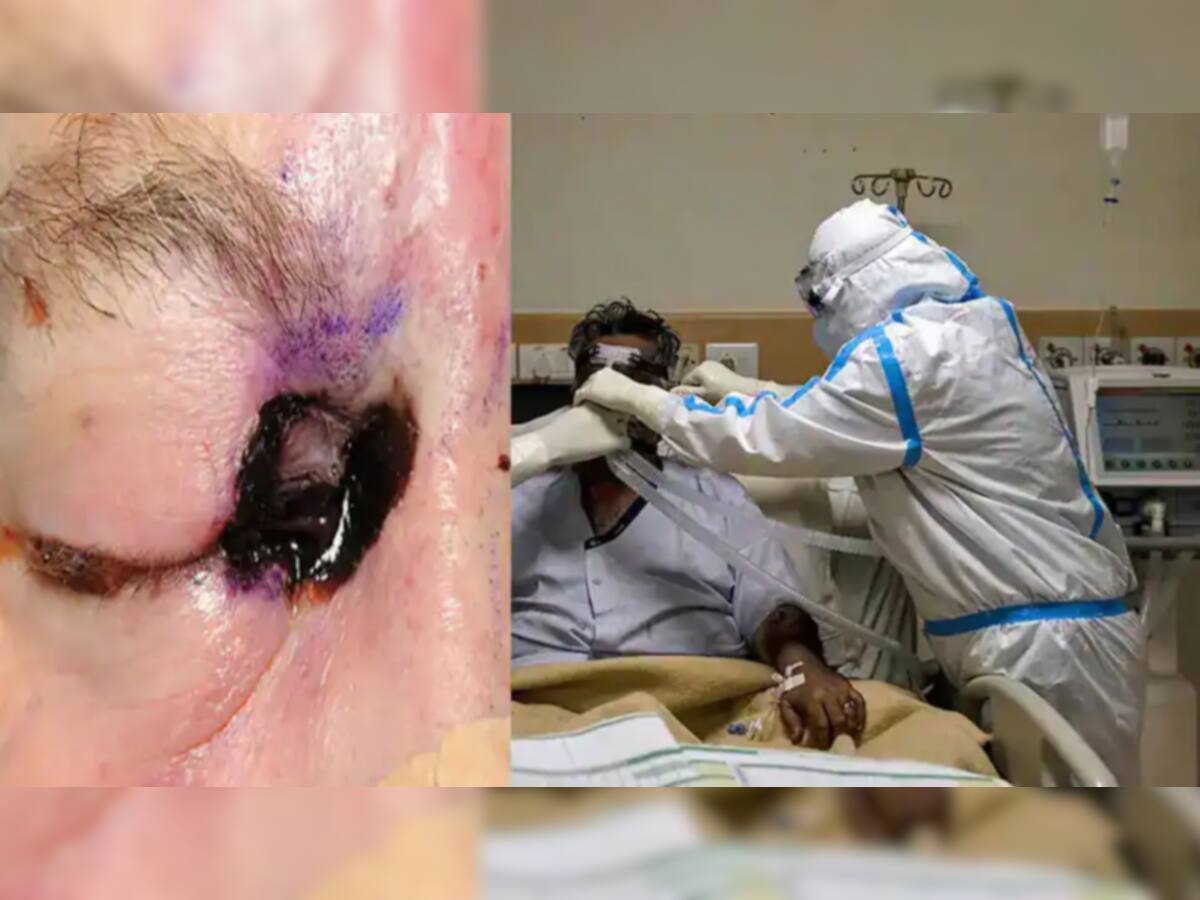 Mucormycosis અંગે ડોક્ટરે આપી ખાસ જાણકારી, આ ભૂલ તમારા માટે સાબિત થશે ખતરનાક