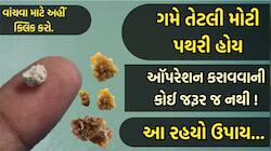 પથરીની પ્રોબ્લેમમાં બધા જ નુસખા ગયા છે ફેઈલ? તો આ ઈલાજથી ઓપરેશન વિના નીકળી જશે પથરી