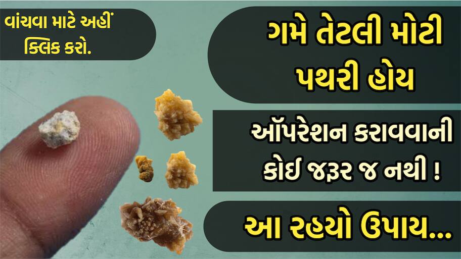 પથરીની પ્રોબ્લેમમાં બધા જ નુસખા ગયા છે ફેઈલ? તો આ રામબાણ ઈલાજથી ઓપરેશન વિના નીકળી જશે ગમે તેટલી મોટી પથરી!