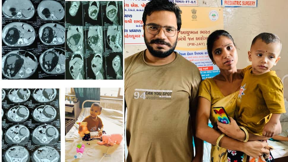 Ahmedabad: 18 માસની બાળકીના પેટમાંથી દૂર કરાયું 400 ગ્રામનું અવિકસિત ભ્રુણ, બાળકીને મળ્યું નવજીવન Ahmedabad: 18 માસની બાળકીના પેટમાંથી દૂર કરાયું 400 ગ્રામનું અવિકસિત ભ્રુણ, બાળકીને મળ્યું નવજીવન