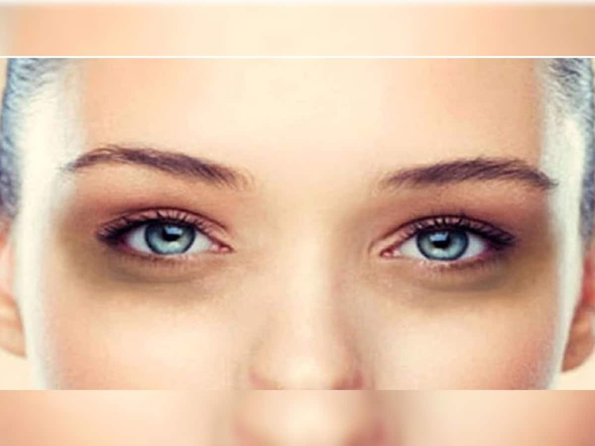 Health Tips: આંખો નજીક ડાર્ક સર્કલ થઈ ગયા છે? તો આ સરળ ઉપાયથી સમસ્યા થશે દૂર