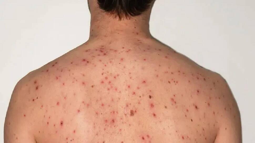 Body Acne: શરીર પરના ખીલથી છુટકારો મેળવવા માટે સવારે અને રાત્રે અનુસરો આ Tips Body Acne: શરીર પરના ખીલથી છુટકારો મેળવવા માટે સવારે અને રાત્રે અનુસરો આ Tips