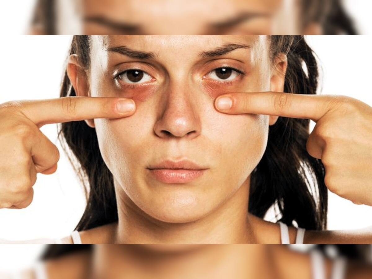 Dark Circles ની સમસ્યા સતાવે છે? ફિકર નોટ..આ ઉપાયથી થઈ જશે સમસ્યાનું સમાધાન