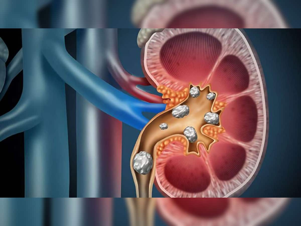 અચાનક પથરીનો દુઃખાવો થાય તો શું કરવું? જાણો પથરીની પીડાનો ઓપરેશન વિના કેવી રીતે થઈ શકે ઈલાજ