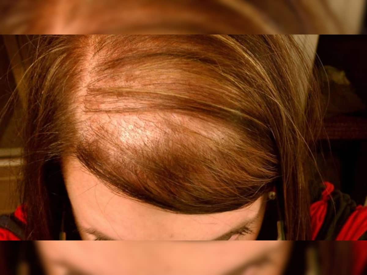 Hair Fall in Women: હેરફોલથી બચવા મહિલાઓ અપનાવે આ ખાસ ઉપચાર, દૂર થશે સમસ્યા