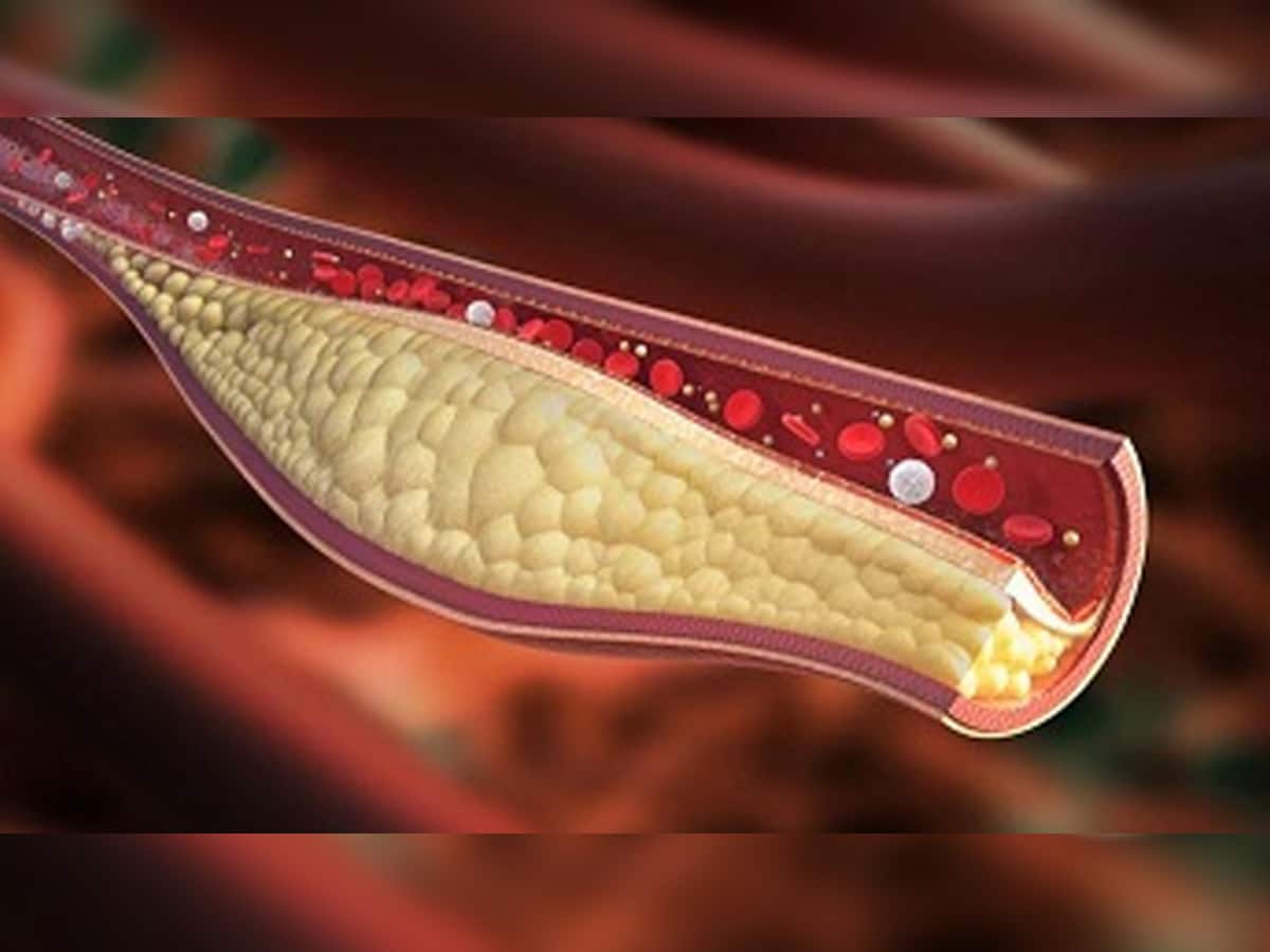 High cholesterol warning Signs: શરીરમાં કોલેસ્ટ્રોલ વધવાના આ 5 વોર્નિંગ ચિહ્નો, હળવાશમાં લેવાની ના કરતા ભૂલ