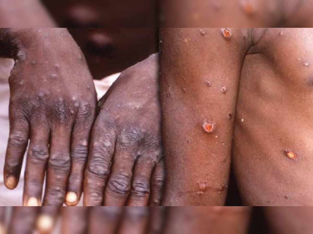 Monkeypox Virus: કોરોના ગયો નથી ત્યાં નવા વાયરસે ચિંતા વધારી, બ્રિટન બાદ હવે આ દેશમાં મળ્યો કેસ