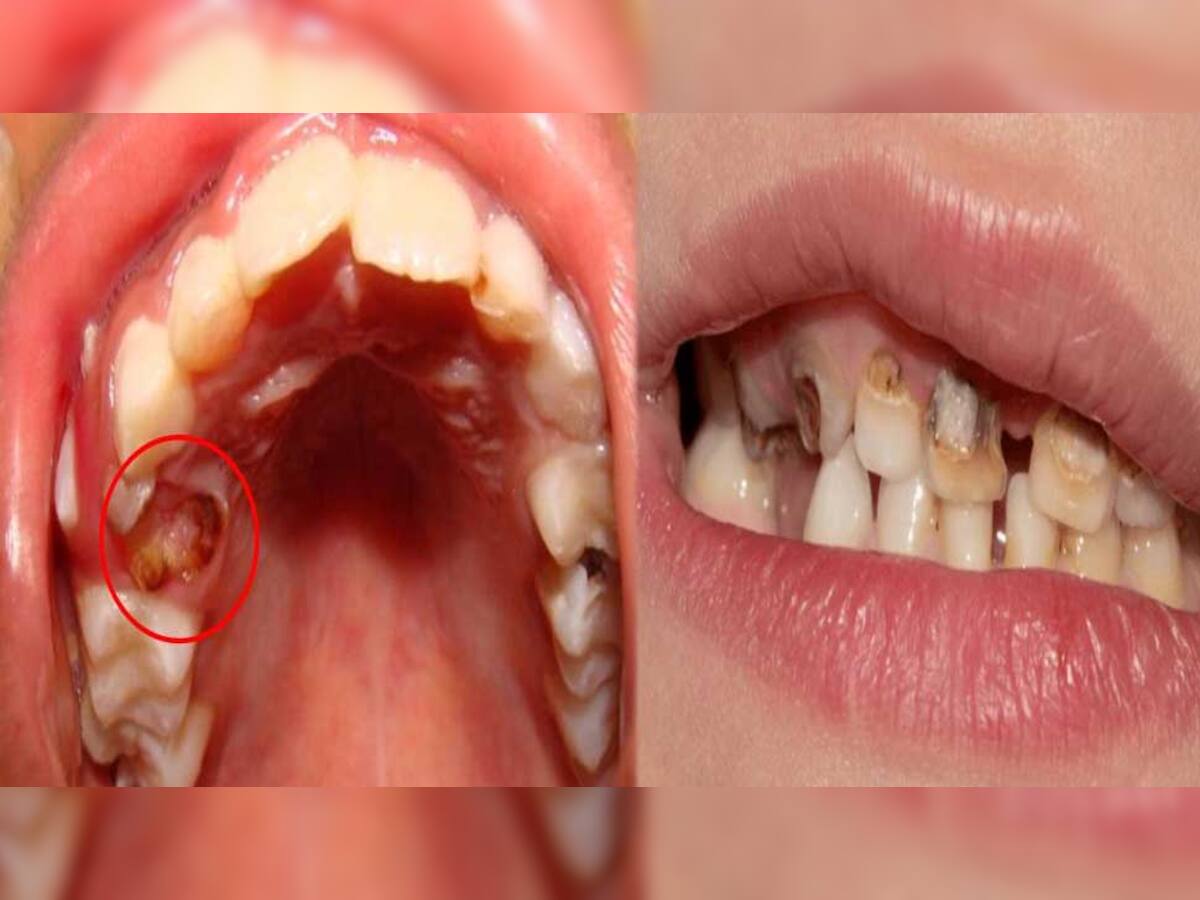 Tooth Decay: શું તમારા દાંતમાં પણ આ રીતે સડો થઈ ગયો છે? તો અજમાવો આ સરળ ઘરેલુ ઉપચાર