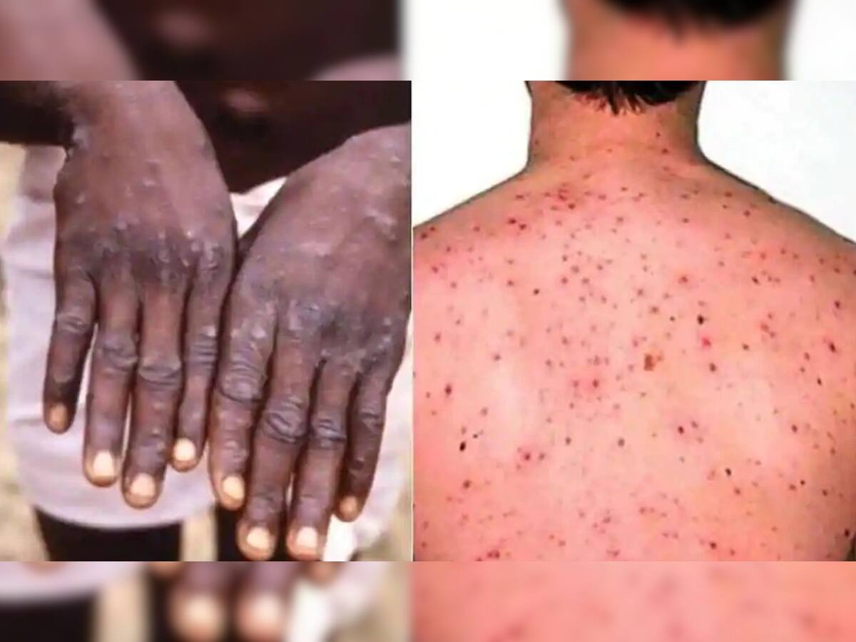 Monkeypox: 29 દિવસમાં 30થી વધુ દેશોમાં લગભગ 600 કેસ, ભારતમાં પણ એલર્ટ