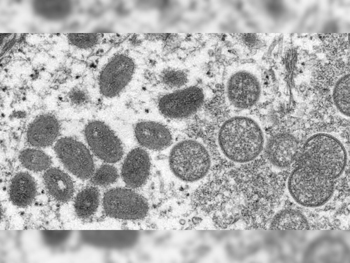Monkeypox: 67 દેશોમાં ફેલાયો આ વાયરસ, યૂરોપમાં 2 અઠવાડિયામાં 3 ગણા કેસ