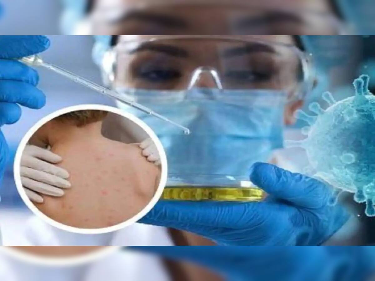 Monkeypox: દેશમાં વધ્યો મંકીપોક્સનો ખતરો, બાળકો માટે થઈ શકે છે ઘાતક, એલર્ટ જાહેર