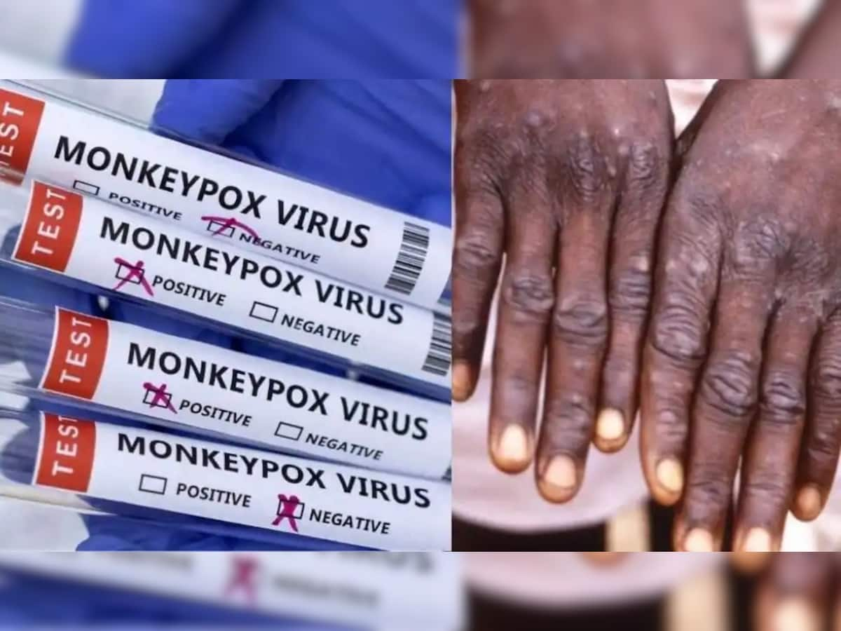 Monkeypox Cases in Delhi: દિલ્હીમાં 31 વર્ષીય મહિલા મંકીપોક્સથી સંક્રમિત, દેશમાં કુલ 9 કેસ નોંધાયા