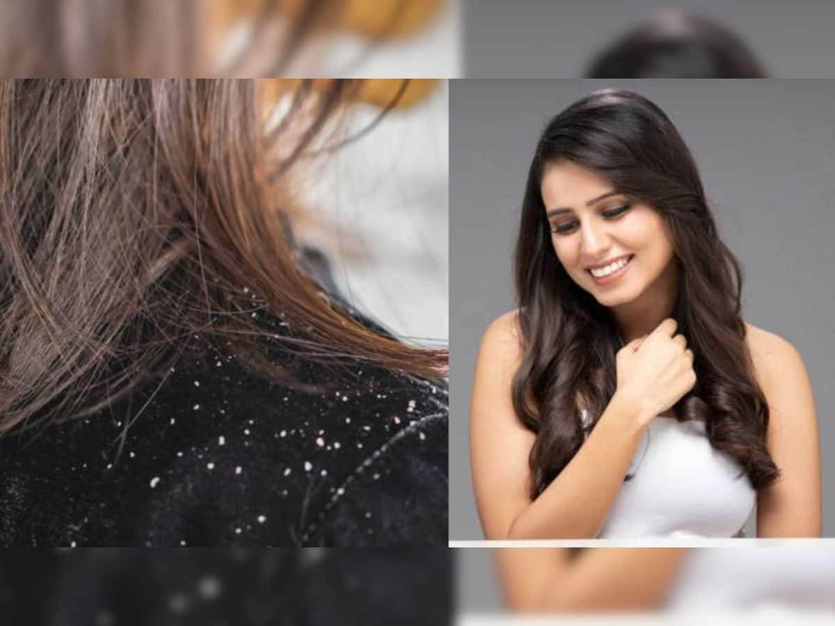 Dandruff Treatment: ફક્ત 10 રૂપિયામાં ખતમ થશે ડેંડ્રફવાળા વાળ, અપનાઓ આ ઘરેલૂ નુસખા