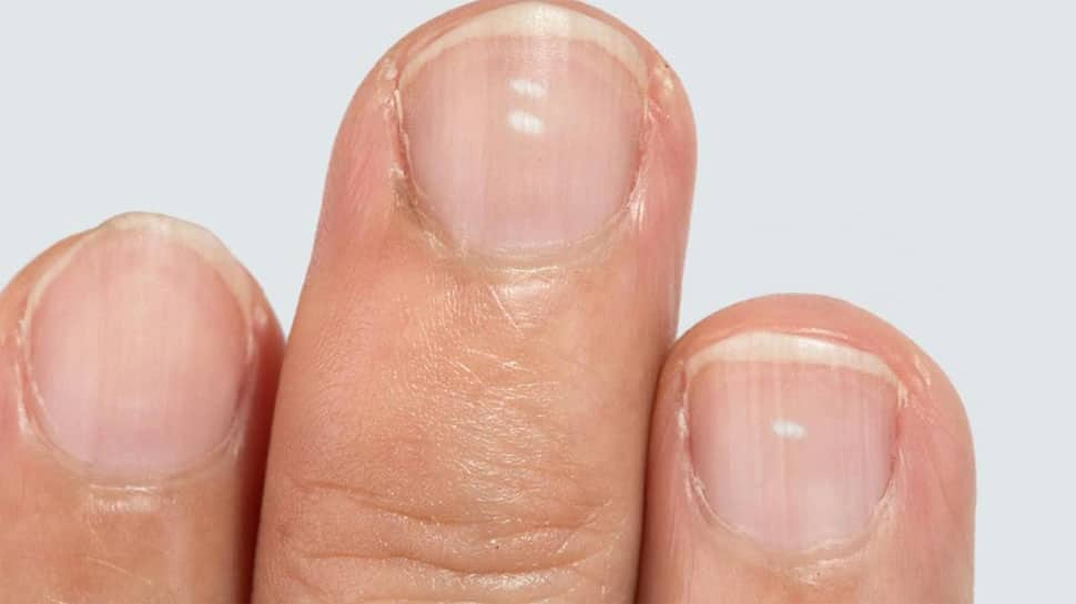 health-tips-causes-of-white-marks-on-nails