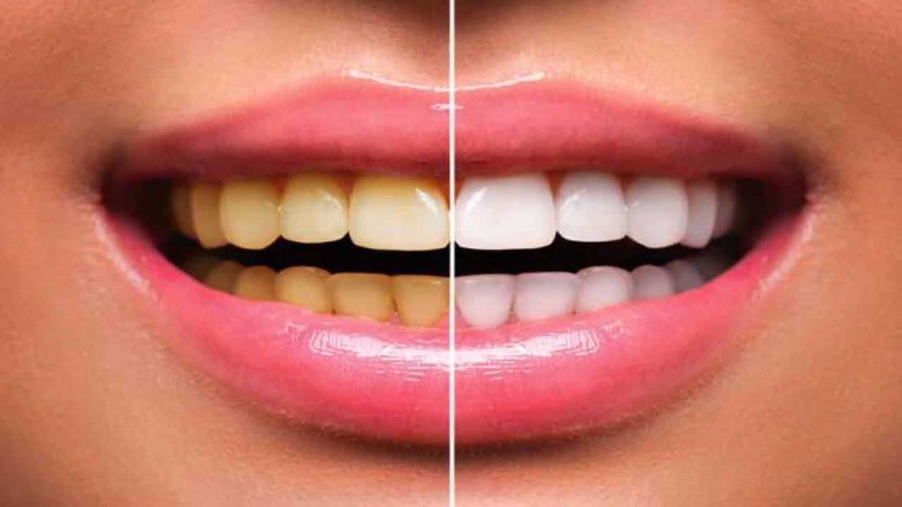 Use baking soda apple cider vinegar to get rid of yellow teeth and