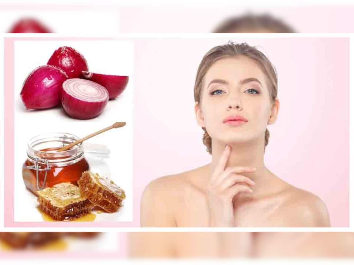 Beauty Remedies: ડુંગળીમાં મિક્સ કરી લગાવો આ વસ્તુ, દૂર થઇ જશે સ્કીનની પરેશાનીઓ, ચાંદ જેવું ચમકશે મુખડું