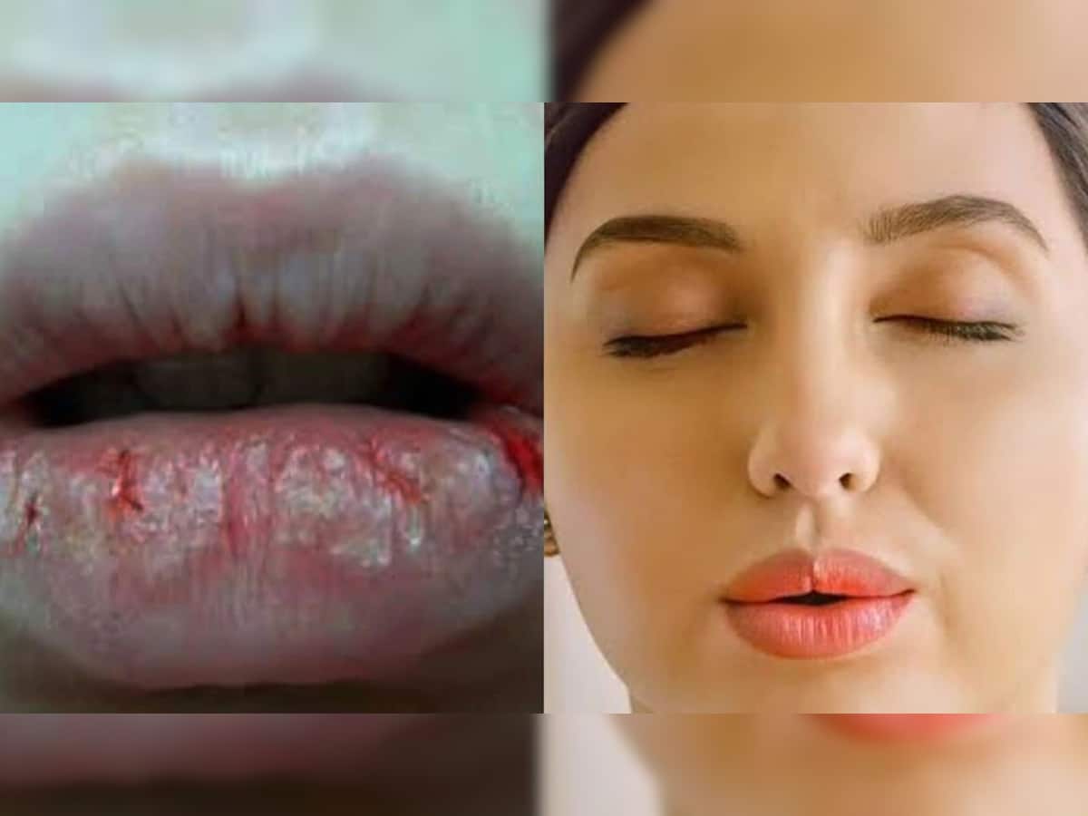 શિયાળાની સિઝનમાં આ કારણોથી ફાટે છે હોઠ, આ રીતે મેળવો Nora Fatehi જેવા Lips