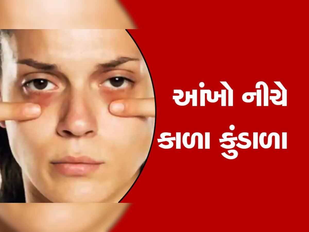 Dark Circles: ચહેરાની સુંદરતા ઓછી કરતા કાળા કુંડાળાને ઘરેલું ઉપચારથી કરો દૂર, ભૂલથી પણ ના કરતા આ પ્રયોગો