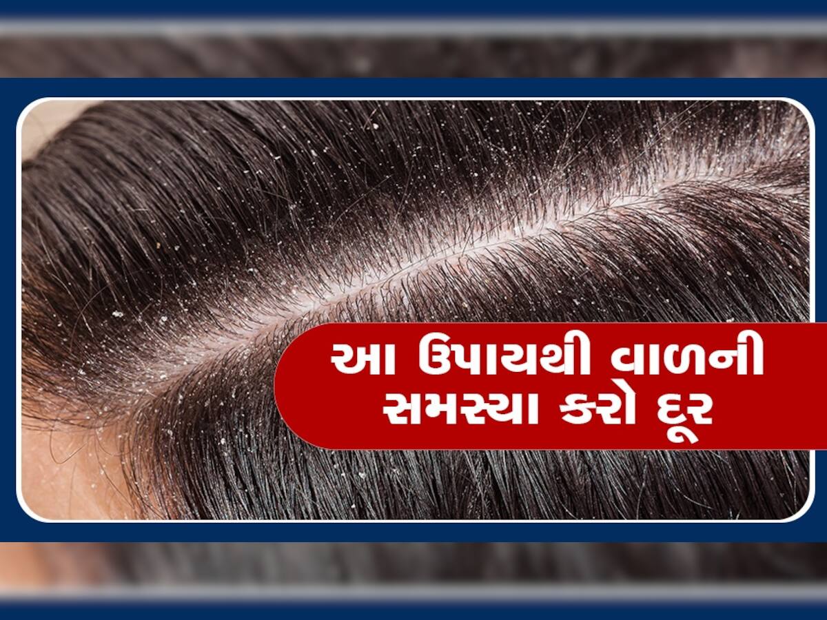 Hair Care Tips: શિયાળાની ઠંડીમાં વાળમાં ડેન્ડ્રફની સમસ્યા છે તો આ કરો ઉપાય, વાળ નરમ અને ચમકદાર બની જશે