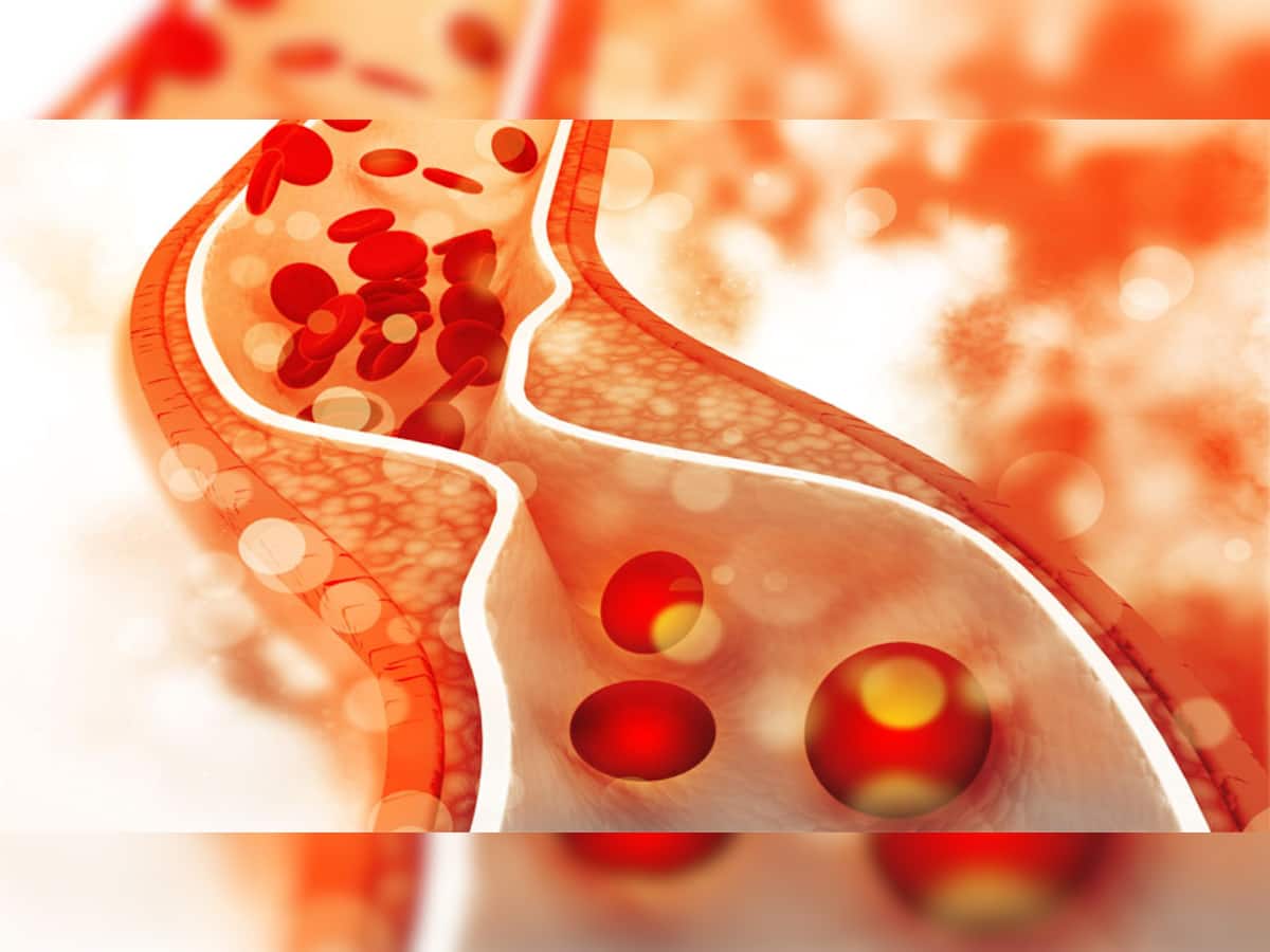 ખરાબ કોલેસ્ટ્રોલનું નામોનિશાન નહીં રહે, આ 10 ઉપાયો કરો, હાઈ Cholesterol માંથી મળશે મુક્તિ