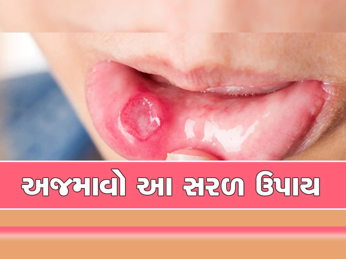 Mouth Ulcer: તમને મોઢામાં ક્યારેય નહીં પડે ચાંદા, બસ કરી લો માત્ર આ 6 ઉપાય