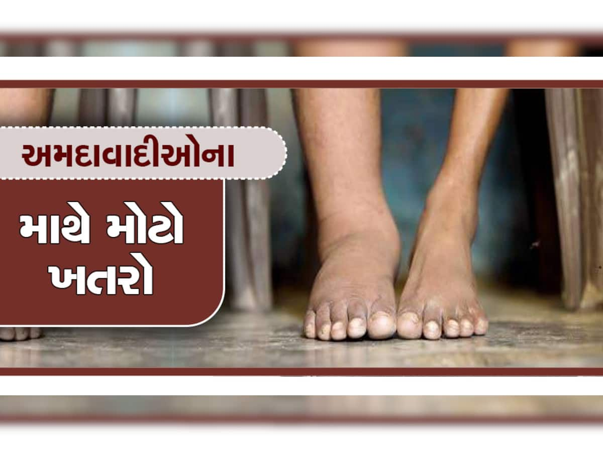 અમદાવાદમાં નવી બીમારીની એન્ટ્રી, આ રોગમા પગ 15 કિલોનો થઈ જશે