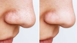 આ ઘરગથ્થુ નુસખા સામે નહીં ચાલે Blackheads ની જીદ, એકવારમાં જ થઈ જશે દુર