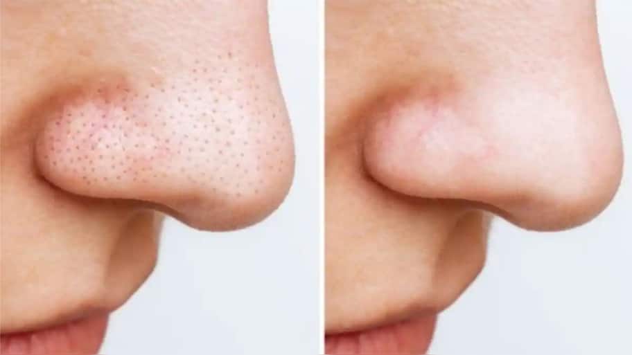 આ ઘરગથ્થુ નુસખા સામે નહીં ચાલે Blackheads ની જીદ, એકવારમાં જ થઈ જશે દુર