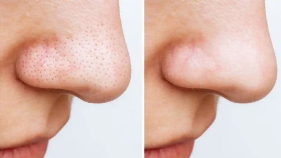 આ ઘરગથ્થુ નુસખા સામે નહીં ચાલે Blackheads ની જીદ, એકવારમાં જ થઈ જશે દુર આ ઘરગથ્થુ નુસખા સામે નહીં ચાલે Blackheads ની જીદ, એકવારમાં જ થઈ જશે દુર