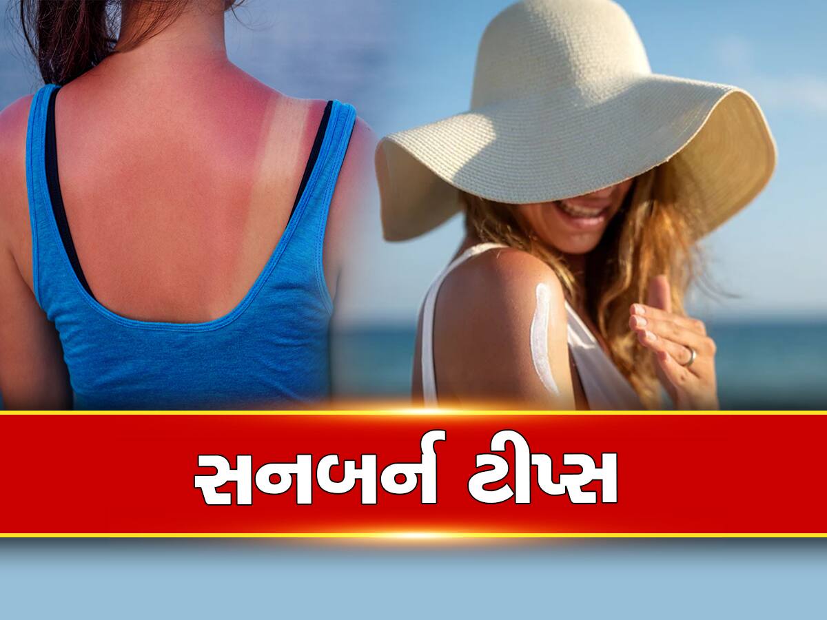 Sunburn Tips: ઉનાળો આવતાની સાથે જ સનબર્નની સમસ્યા? આ એક વસ્તુને રોજ લગાવો, ખીલી ઉઠશે ચહેરો 