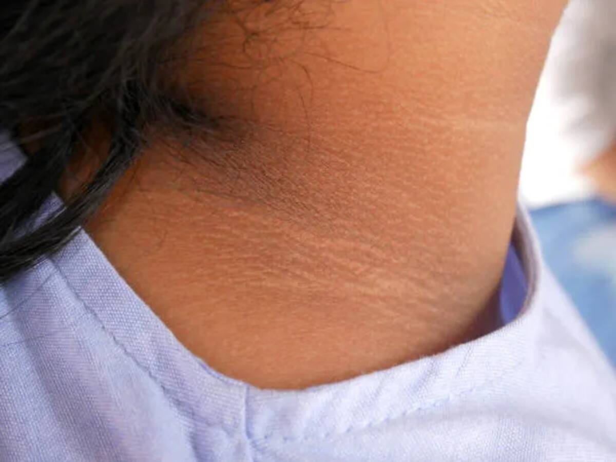 Dark Neck: ગરદન પર જામી ગયો છે કાળો મેલ? તો અપનાવો આ અસરકારક ઘરેલું ઉપાય