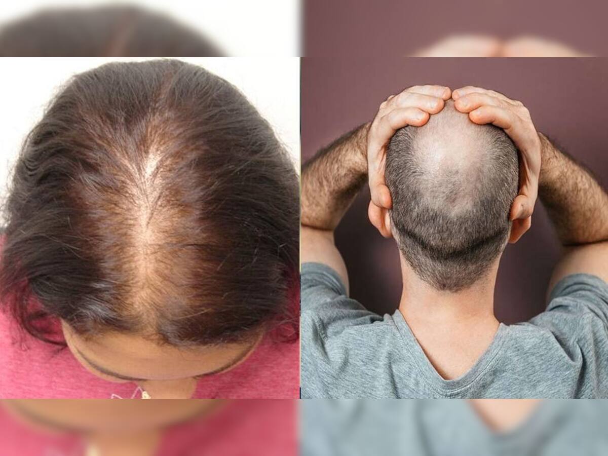 Hairfall Solution: વાળ ખરવાની સમસ્યા છે તો આ ઘરેલુ નુસખાઓ અજમાવો, વાળની સમસ્યાઓથી મળશે મુક્તિ