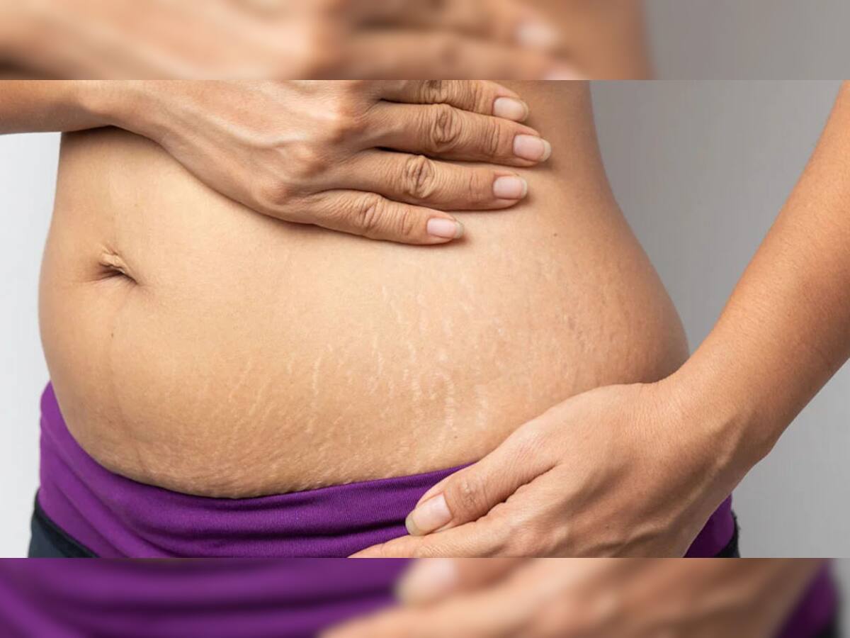 Stretch Marks: શરીર પર સફેદ સ્ટ્રેચ માર્કસ પડી ગયા છે? તો આ તેલનો ઉપયોગ ફાયદો કરશે