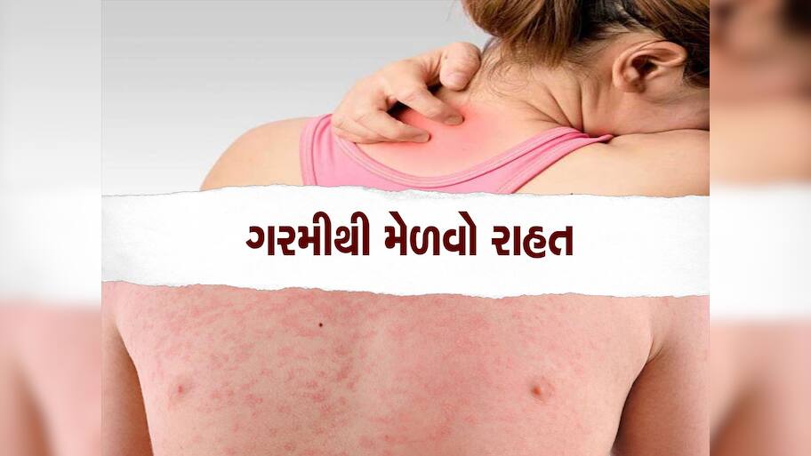 Prickly Heat: શરીર પર નીકળતી ગરમીથી પરેશાન છો, કરો આ ઘરેલું ઉપાય ...