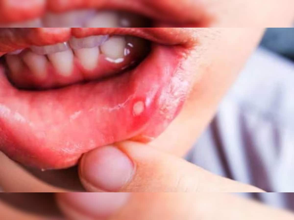 Mouth Ulcer થી તુરંત મળશે રાહત, જોરદાર અસર કરે છે રસોડામાં રહેલી આ વસ્તુ ચાંદા પર