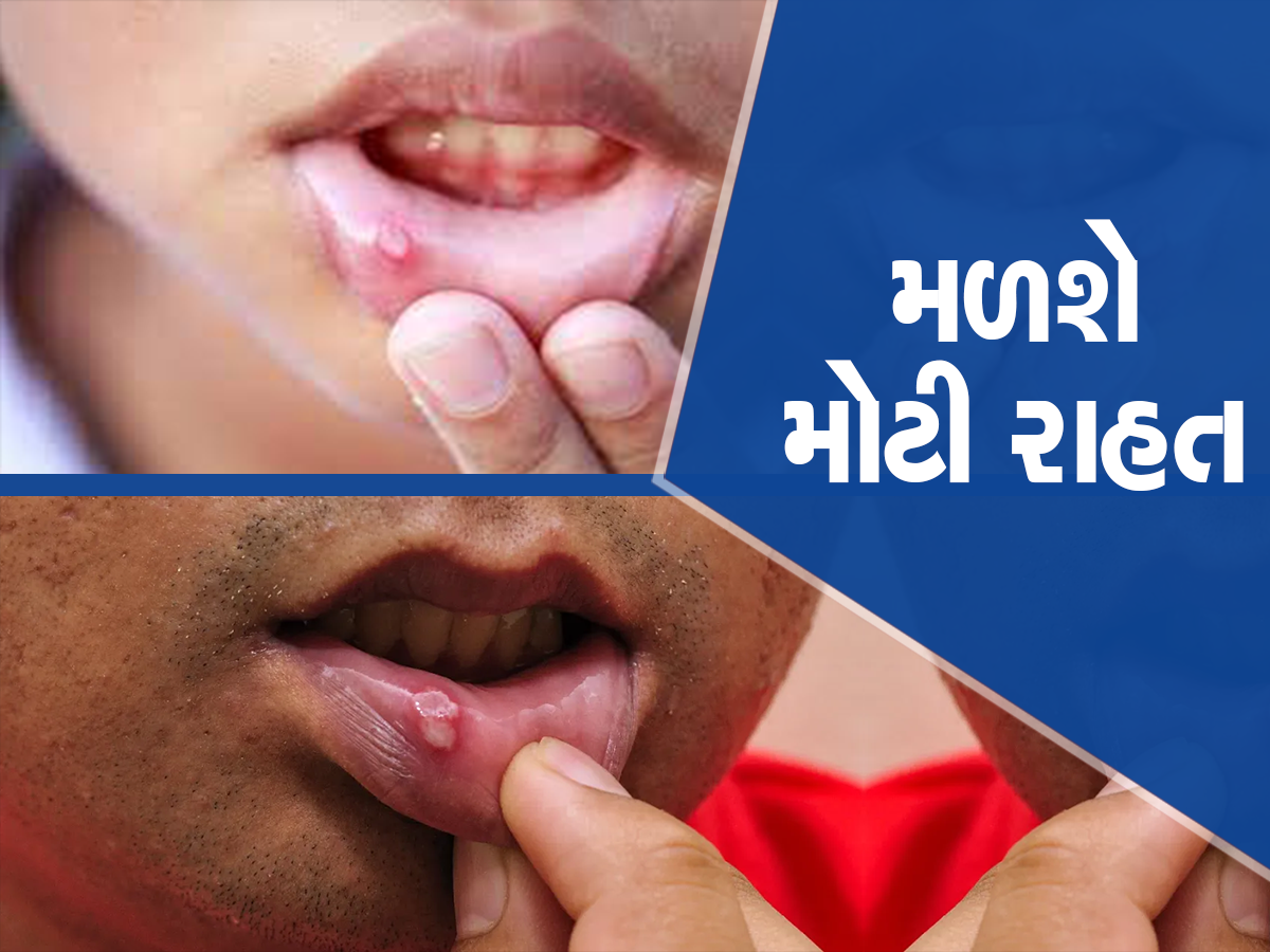 Mouth Ulcers: શું ગરમીને કારણે વારંવાર મોઢામાં પડે છે ચાંદા? અજમાવો આ 5 ઘરગથ્થુ ઉપાય