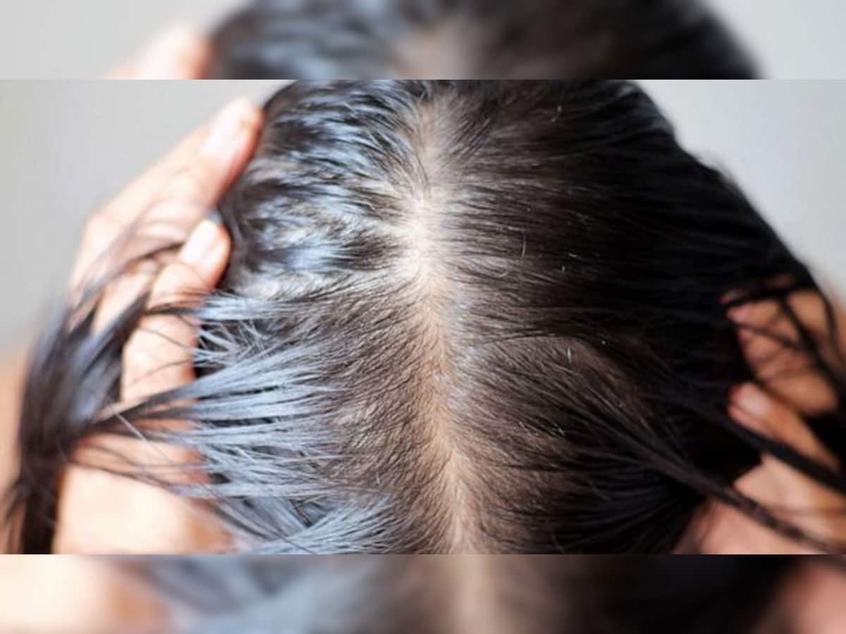 Hair Care: ખરતા વાળના કારણે પડી છે ટાલ ? આ વસ્તુઓ ખાવાનું કરો શરુ, ઝડપથી આવશે નવા વાળ