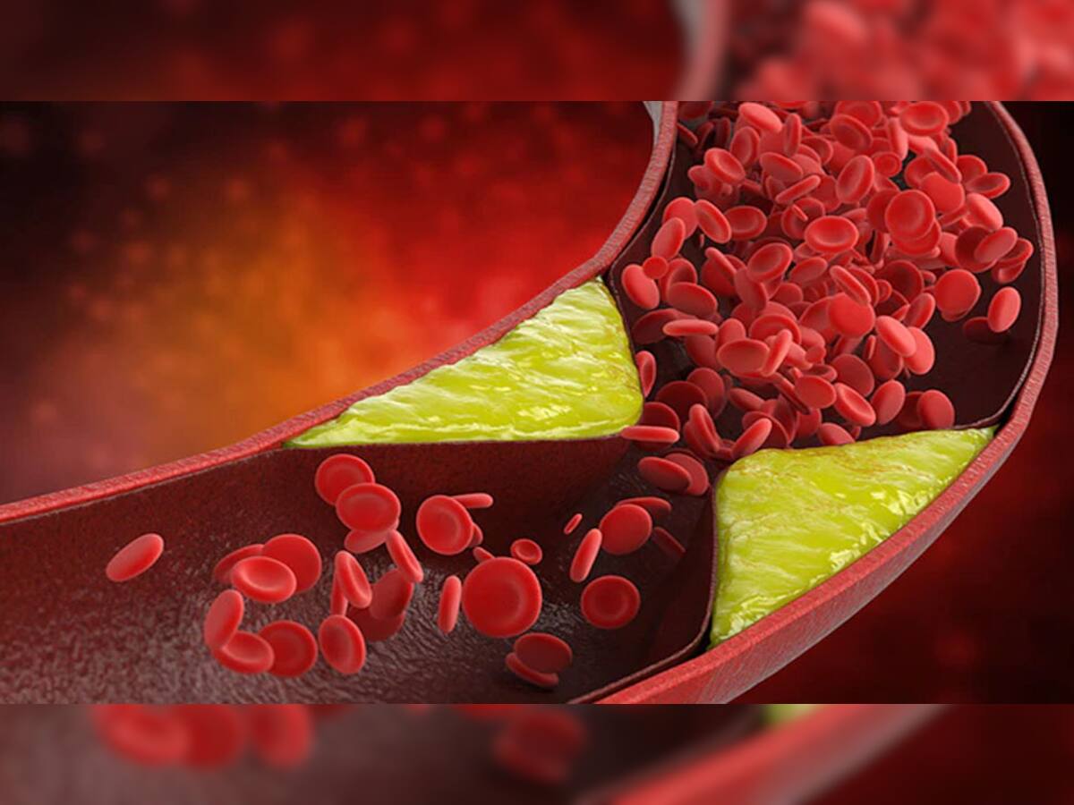 Bad Cholesterol: ડાયટમાં સામેલ કરો આ વસ્તુઓ, ઝડપથી ઓછું થશે બેડ કોલેસ્ટ્રોલ