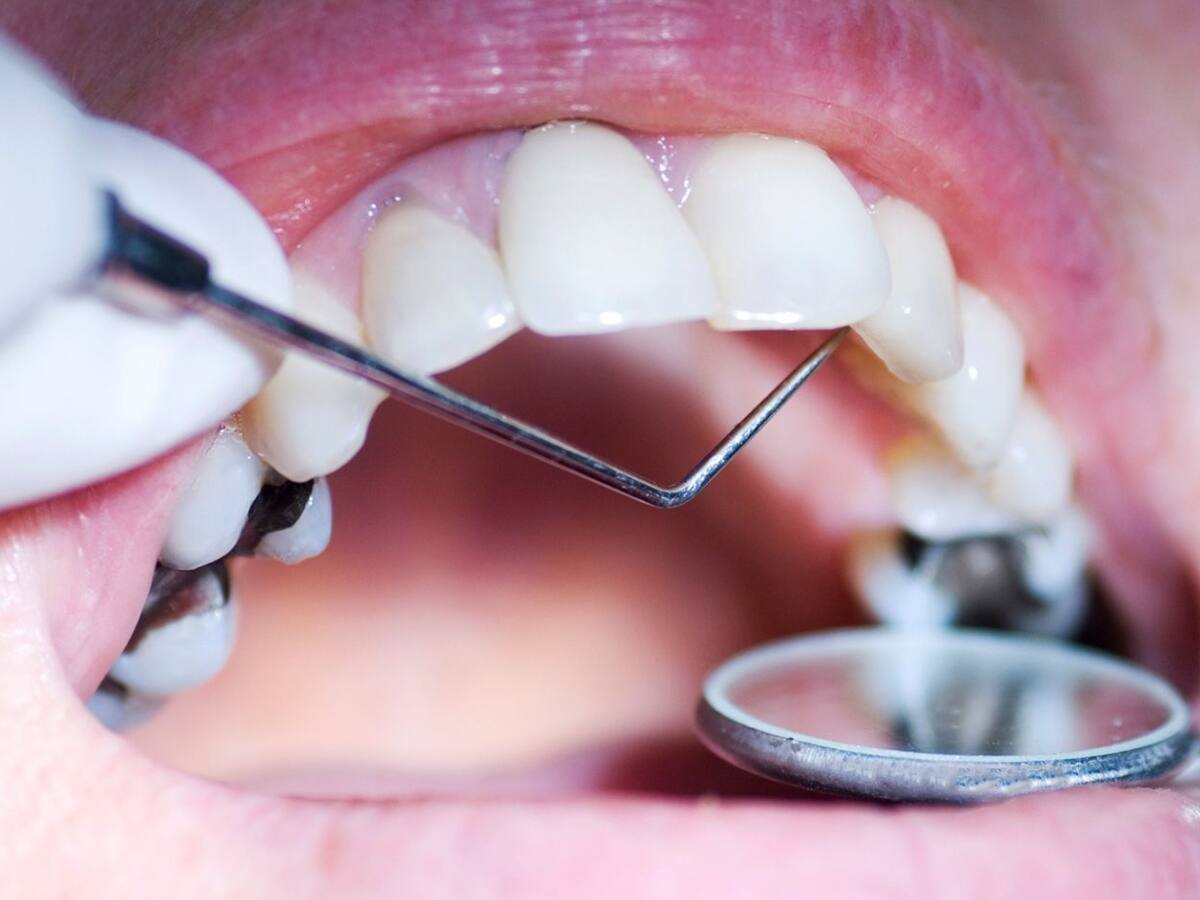 Teeth Cavity: શું તમે પણ દાંતમાં કેવિટી કે સડાથી પરેશાન છો? તો બચવા માટે અજમાવો આ ઉપાય