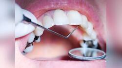 Teeth Cavity: શું તમે પણ દાંતમાં કેવિટી કે સડાથી પરેશાન છો? તો અજમાવો આ ઉપાય