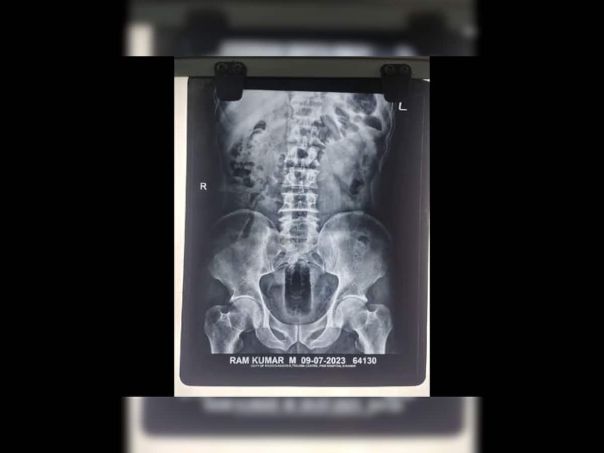 કમર નીચે દુ:ખાવો થતા મજૂર હોસ્પિટલ પહોંચ્યો, ગુપ્તાંગનો X-ray જોઈને ડોક્ટરોના હોશ ઉડ્યા
