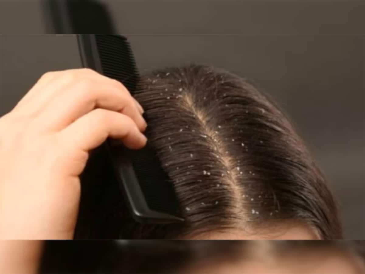 Hair Care Tips: જીદ્દી ડેન્ડ્રફ 15 દિવસમાં થશે દુર અને પછી ક્યારેય દેખાશે પણ નહીં, અજમાવો આ ઘરગથ્થુ ઉપાય