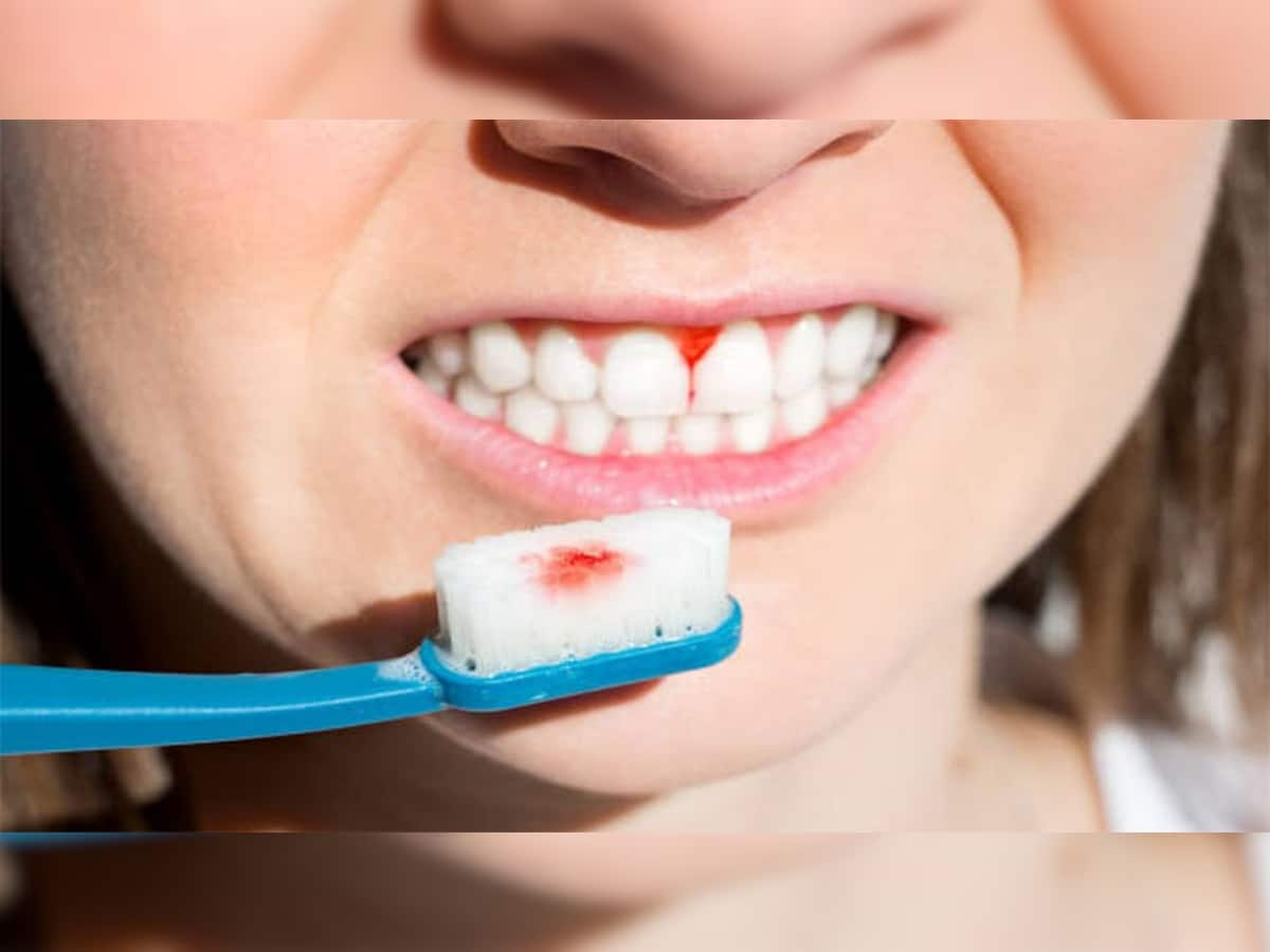 Gum Bleeding: બ્રશ કરતી વખતે પેઢામાંથી લોહી નીકળે તો અપનાવો આ 3 માંથી કોઈ એક ઉપાય, તુરંત દેખાશે અસર