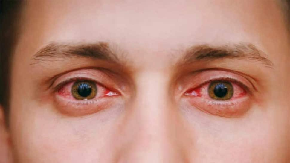 Eye Infection: આંખ આવી હોય ત્યારે ન કરવું આ કામ, કરશો તો થઈ જશો આંધળા, તુરંત કરો ડોક્ટરનો સંપર્ક | Health News in Gujarati mistakes done during Eye Infection cause blindness know