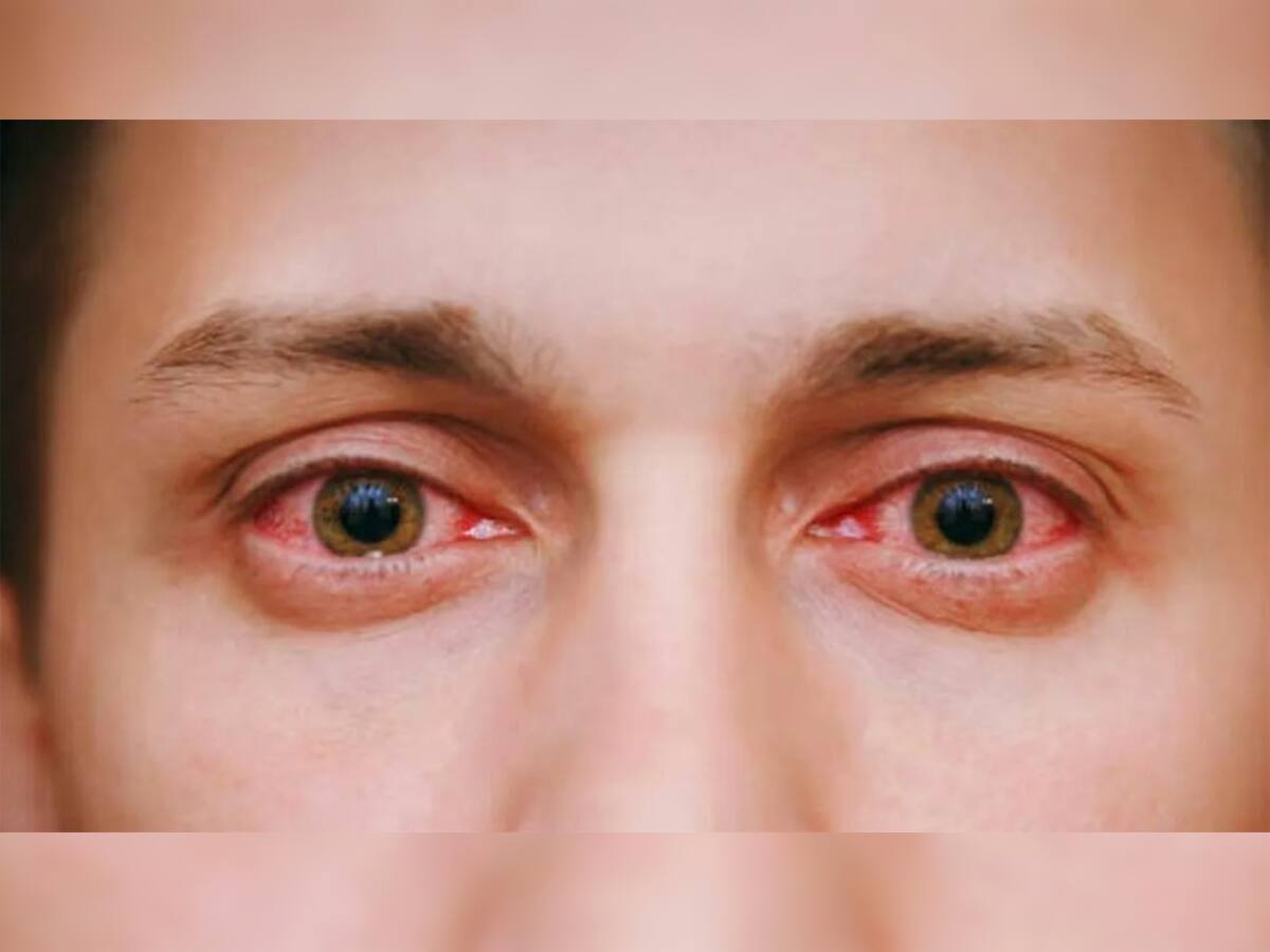 Eye Infection: આંખ આવી હોય ત્યારે ન કરવું આ કામ, કરશો તો થઈ જશો આંધળા, તુરંત કરો ડોક્ટરનો સંપર્ક