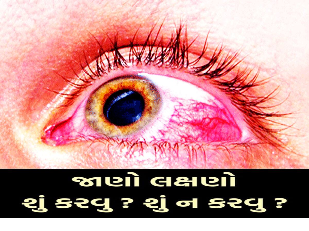 CHILD EYE FLU: બાળકોમાં તેજીથી ફેલાઈ રહ્યો છે Eye Flu, જાણો આઈ ફ્લૂના લક્ષણો અને તેના ઉપચાર