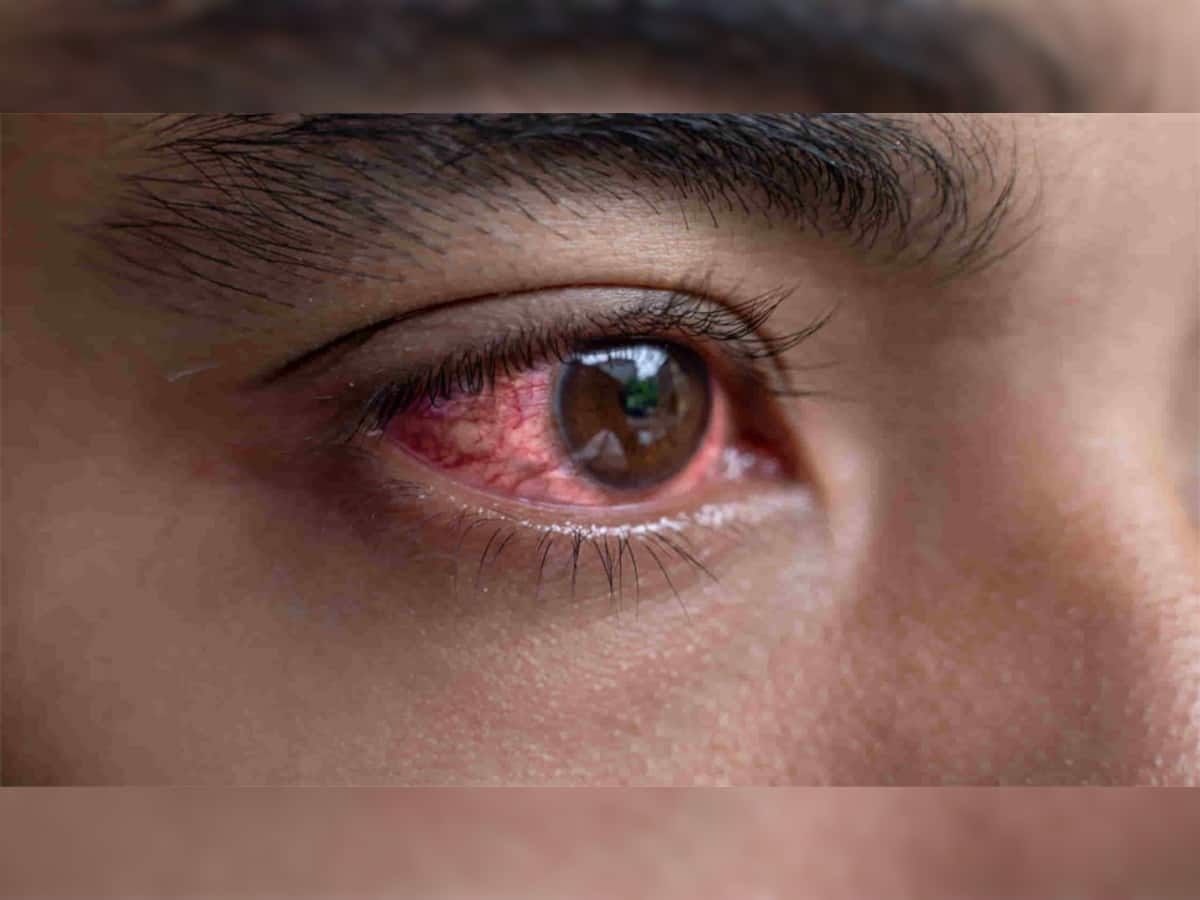 Eye Flu: જો તમને કે પરિવારમાં કોઈને પણ આવી હોય આંખ તો તુરંત અજમાવો આ ઘરેલુ નુસખા