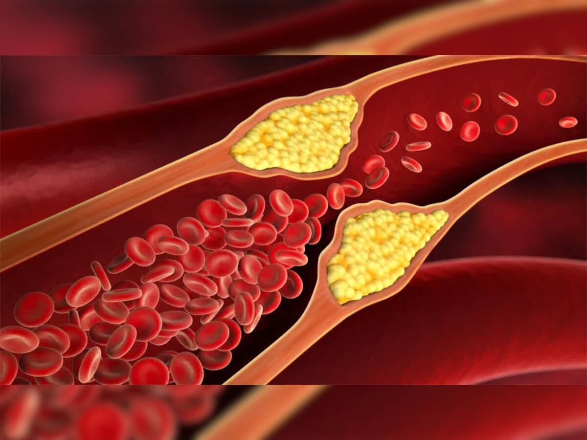 Bad Cholesterol: ખરાબ કોલેસ્ટ્રોલને શરીરમાંથી બહાર કાઢી નાખશે આ ઘરેલુ વસ્તુઓ, ટ્રાય કરી જુઓ એકવાર